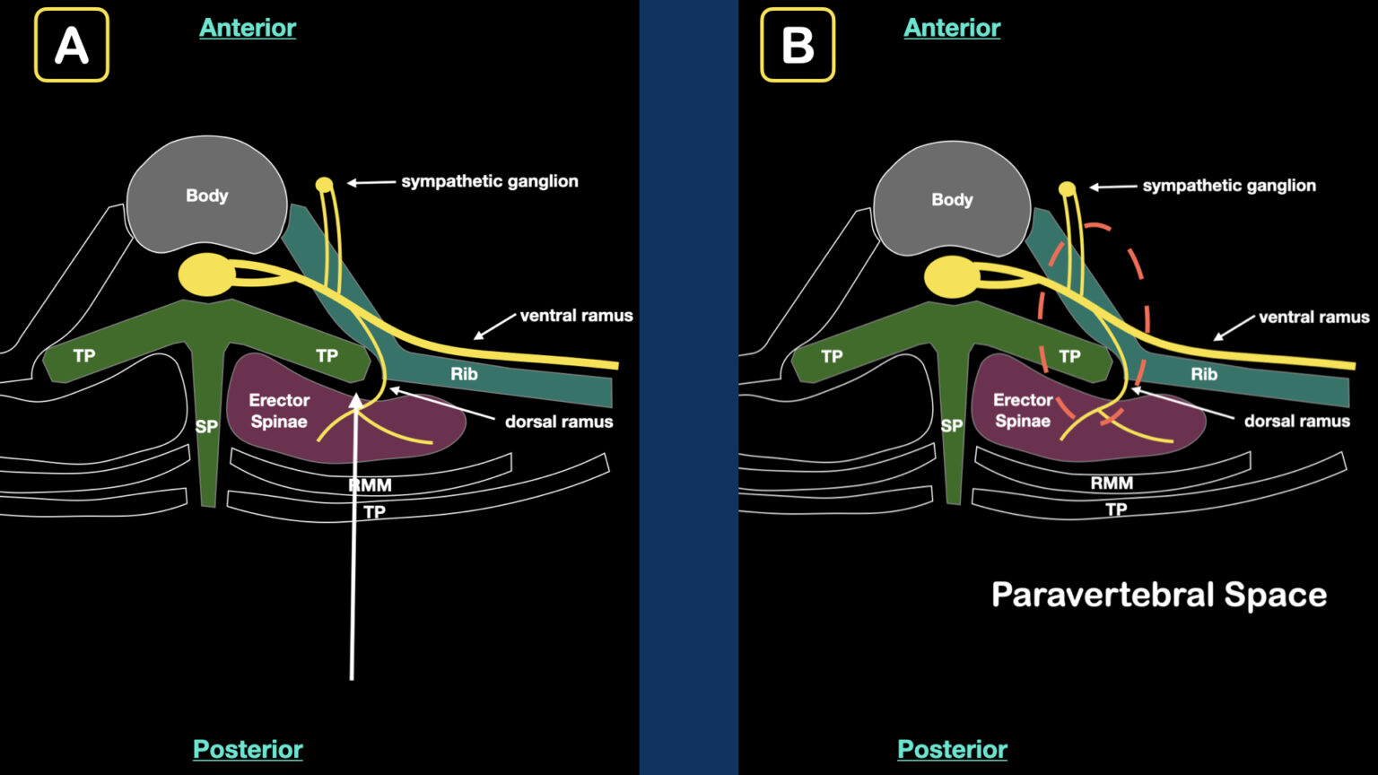 Erector Spinae Plane Block Fig Acep Now