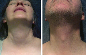 Female versus male external anatomy: The thyroid prominence is evident in the male, whereas the thyroid and cricoid have equal prominence in a female.