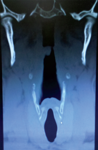 Figure 3. CT imaging of the larynx in a coronal projection showing the epiglottis; the piriform recesses lateral to the epiglottis; the hyoid (bright dots); thyroid lamina; and, lowest and most medial, the cricoid. The vocal cords are at the inferior aspect of the thyroid cartilage. Note the rhomboid shape from the hyoid to the thyroid and cricoid and that the lower thyroid encircles the cricoid. 