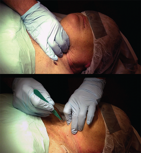 Figure 5. The laryngeal handshake, starting on right side with dominant hand (top), then switching to the nondominant hand on larynx, with the dominant hand getting ready to make the incision (bottom). 