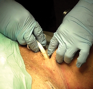 How to Make the Incision, Insert the Tube in Cricothyrotomy 