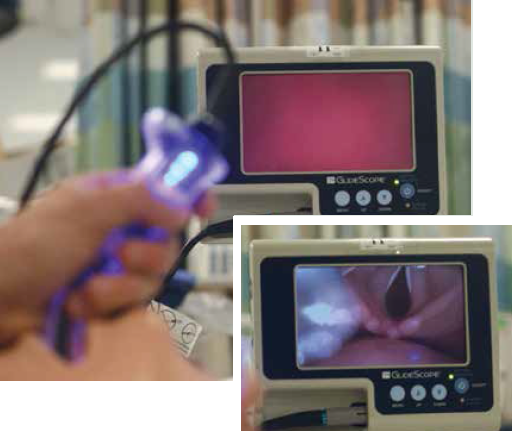 Figure 7. Push 5 mL increments of normal saline through the IV tubing to clean the lens.