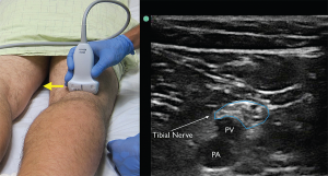 Figure 4. The tibial nerve sits just above the popliteal artery (PA) and popliteal vein (PV). Identification of this nerve is the first step in identifying the larger and more proximal distal sciatic nerve. Yellow arrow indicates direction of probe marker.