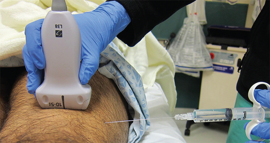 Figure 6. Ultrasound and needle placement for the distal sciatic nerve block in the popliteal fossa. Note the flat needle entry lateral to the transducer.