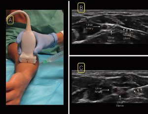 Figure 5. For the ulnar nerve block, position the linear ultrasound at the wrist over the ulnar artery (A). Scan proximally until the nerve separates from the artery in the ulnar direction in the mid-to-proximal forearm (B). insert your needle from the ulnar (medial) aspect of the probe (A&C).