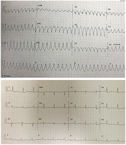 Figure 2. This patient’s elevated aVR was associated with three-vessel disease.