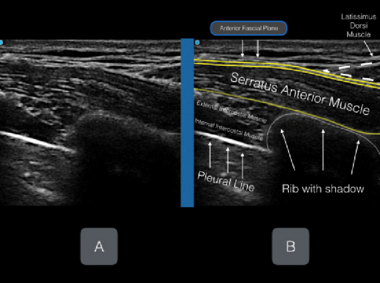 Ultrasound-Guided Serratus Anterior Plane Block Can Help Avoid Opioid ...