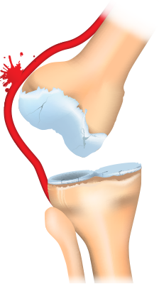 Anterior knee dislocation.