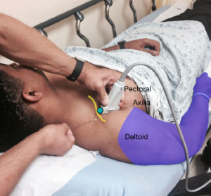 Figure 2: Stand above the patient with the ultrasound screen in clear view. Note the transducer is located in the deltopectoral groove with the needle entering above the clavicle.