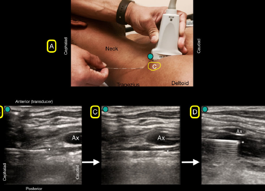 Figure 4A: A flat needle angle will be used to traverse under the clavicle (C). 4B: The bock needle will have to pass under the clavicle and will not be visualized. Note the needle tip as it emerges from under the clavicle and can be easily seen because of its flat angle. 4C: The block needle is advanced until placed just under the axillary artery (Ax). 4D: Anechoic anesthetic fluid is injected under the axillary artery (Ax) for a successful block.