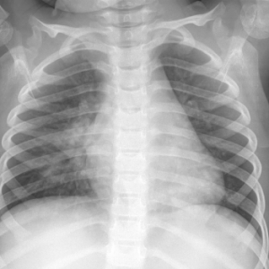 Chest X-ray of a 3-year-old female patient with signs of pneumonia showing a right perihilar infiltrate.