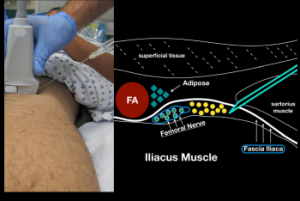 Figure 6: When performing an in-plane lateral to medial approach to the ultrasound-guided femoral nerve block, obtain clear sonoanatomy by proper probe positioning. Try to get your block needle just under the fascia iliaca (lateral to the femoral nerve) and inject anesthetic gently.