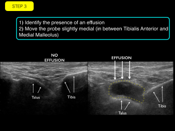 Using Point-of-Care Ultrasound to Evaluate and Aspirate Ankle ...