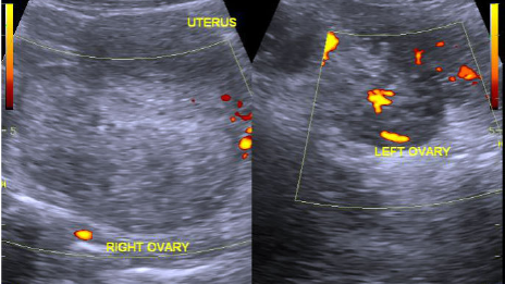 Figure 1 (ABOVE) Ovarian torsion on ultrasound with enlarged ovary and absent vascular flow.