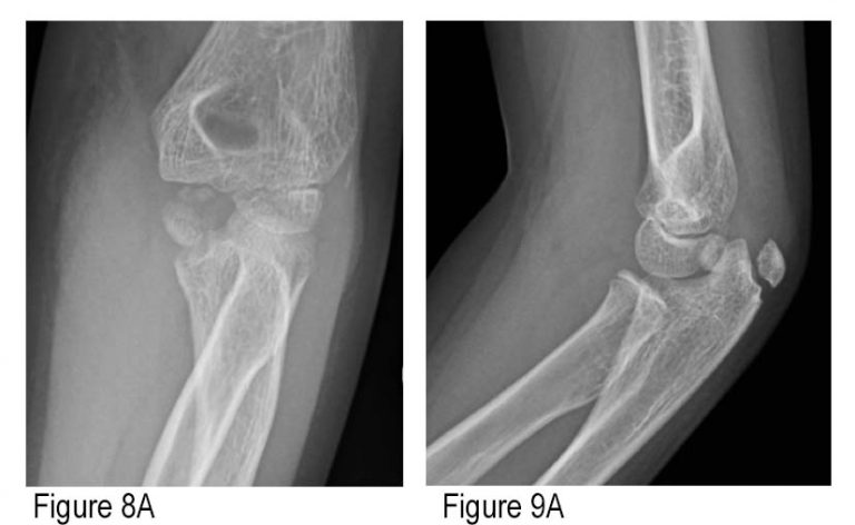 How to Avoid Missing a Pediatric Elbow Fracture - ACEP Now