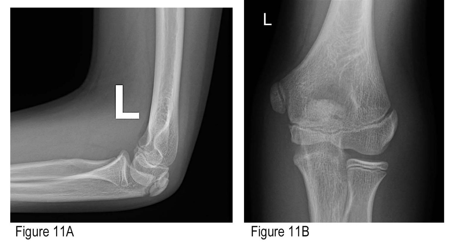 How To Avoid Missing A Pediatric Elbow Fracture Acep Now