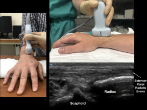 Figure 2: Rotate the ultrasound transducer in a longitudinal plane (compared to the radius) with the probe marker pointing distal. In a patient with no effusion, the distal radius and scaphoid bone with minimal anechoic fluid should be noted. 