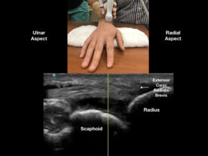 Figure 4: With the ultrasound probe covering the extensor carpi radials brevis, enter the swollen joint capsule with an out-of-plane technique. We recommend a steep needle angle of entry between Lister’s tubercle and the extensor carpi radials brevis. The procedure should be performed with sterile precautions (like any other joint aspiration). 