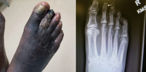 Figure 1(LEFT): Gross observation of the right foot demonstrates gangrene with purulence, edema, and absent distal phalanx. Figure 2(ABOVE): X-ray of right foot revealing osteomyelitis of the second middle phalanx (arrow) and absent second distal phalanx in AP view.