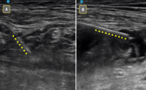 Figure 4A: Poorly visualized needle due to low angle of insonation. Figure 4B: Improved needle visualization after “toeing in” transducer.