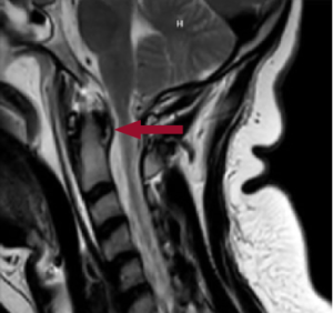 Figure 2: MRI showing a subdural hematoma at the cervical medullary junction causing stenosis to the spinal canal just inferior to the foramen magnum