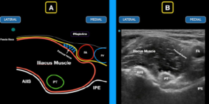 Figure 4: Schematic drawing (A) and ultrasound image (B) of the classic location of the PENG block. Note the fascia iliaca in relation to the femoral nerve, femoral artery (FA), and femoral vein (FV). Note the anterior inferior iliac spine (AIIS), iliopubic eminence (IPE), and psoas tendon (PT).