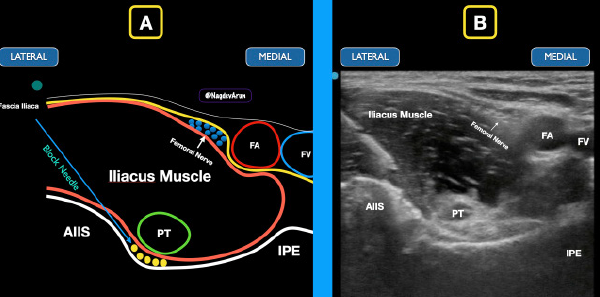 Figure 5: The block needle comes from a lateral to medial approach to deposit anesthetic under the iliacus muscle. The goal is to spread anechoic anesthetic (yellow circles) under the psoas tendon between the iliacus muscle and the bony ramus.