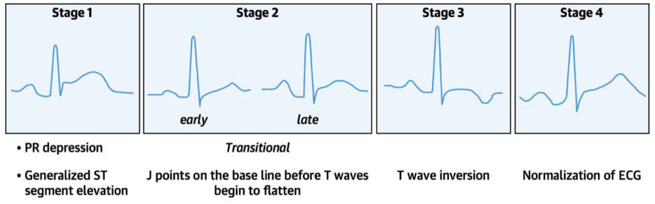 electrocardiogram screenshot July 2022 - ACEP Now