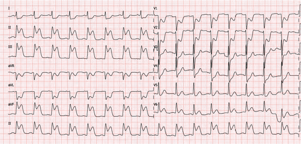 Revisiting Nitroglycerin in MI with Right-Side Ventricular Involvement ...