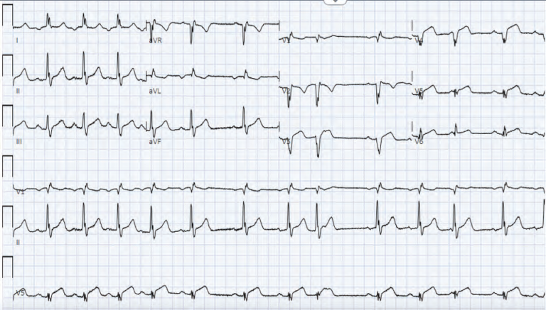 cardiac stemi 1 april 2024 - ACEP Now