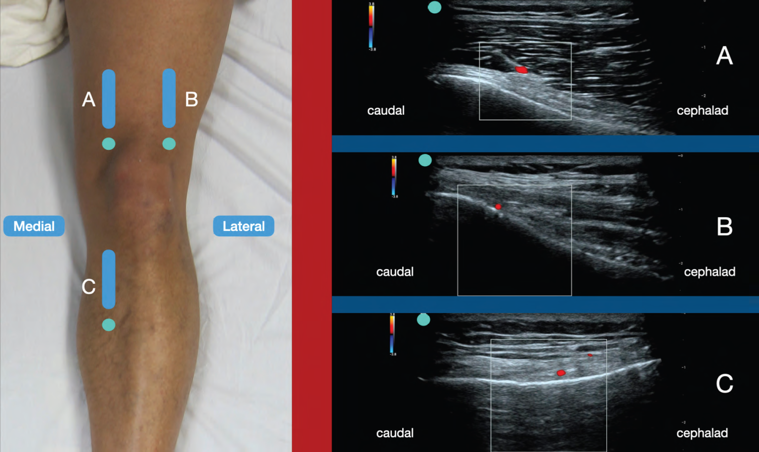 The Ultrasound-Guided Genicular Nerve Block - ACEP Now